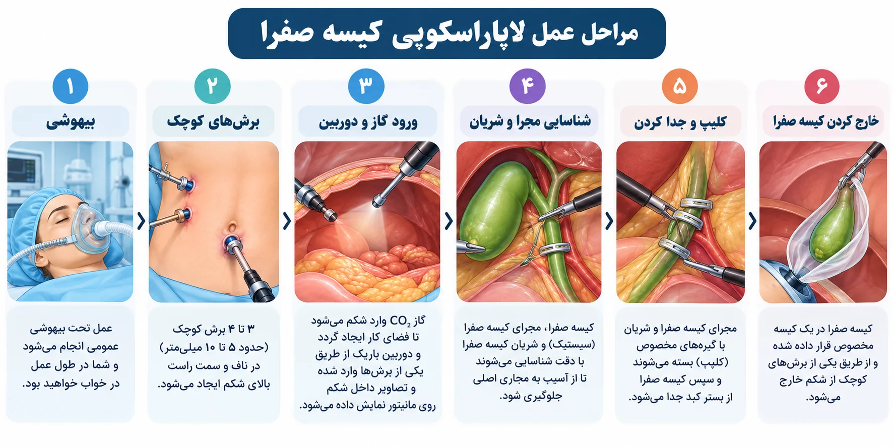 مراحل عمل لاپاراسکوپی کیسه صفرا به ترتیب