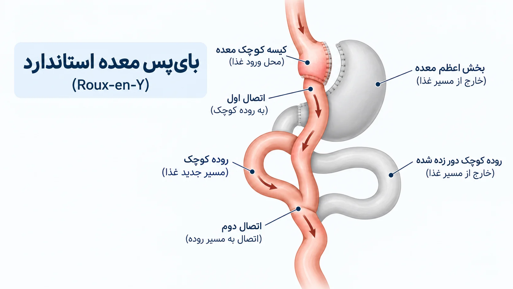 نمای شماتیک بای پس معدهی کلاسیک (Roux-en-Y)