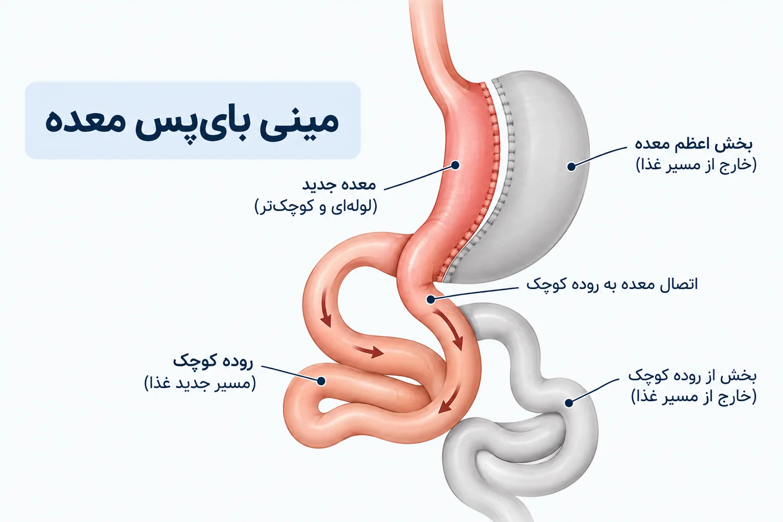 نمای شماتیک عمل مینی بای پس معده