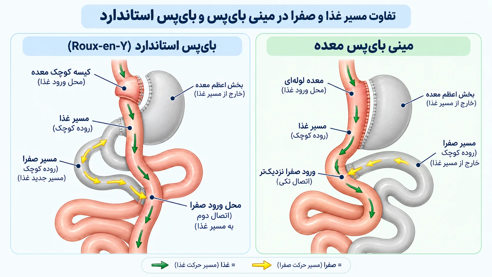 مقایسهی کنار هم دو روش: سمت راست مینی بای پس و سمت چپ بای پس استاندارد