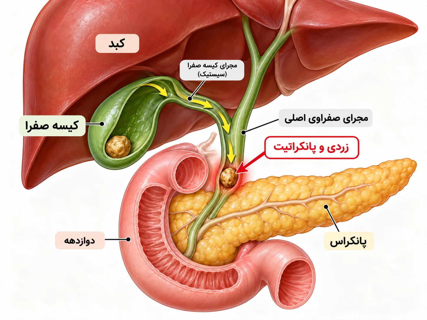 آناتومی کیسه صفرا و مسیر حرکت سنگ به مجرای صفراوی